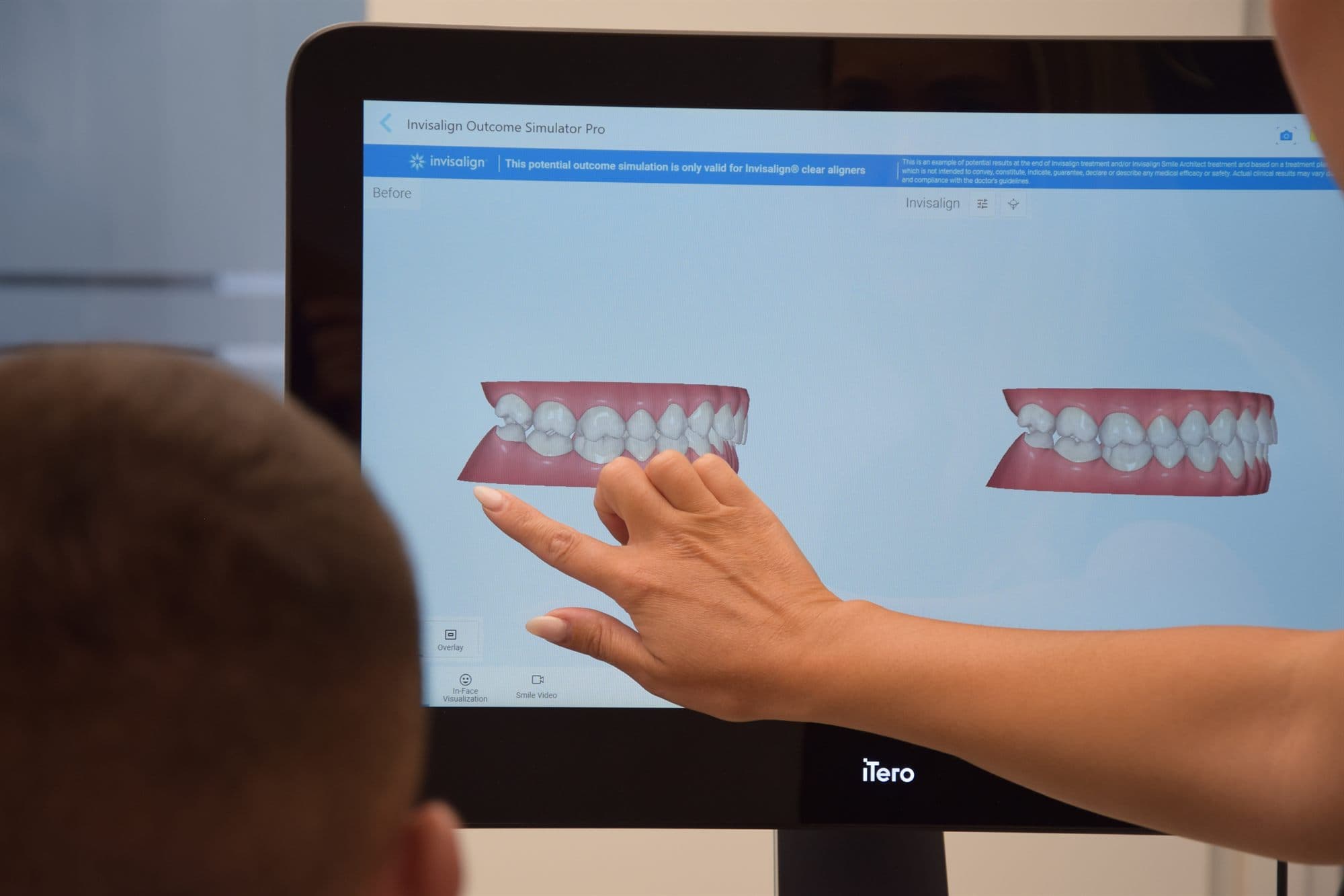 Д-р Камборлиева показва на екрана на iTero симулация „преди и след“ в Invisalign Outcome Simulator Pro